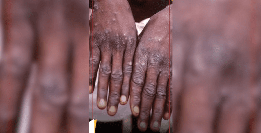 ކެރެލާއިން އެމްޕޮކްސް އާ ވޭރިއެންޓް ފެނިއްޖެ