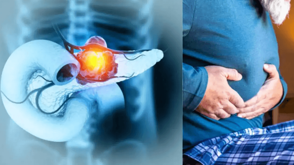 ސްޕެއިންގެ ސައިންސްވެރިން ޕެންކްރިއެޓިކް ކެންސަރަށް ފަރުވާއެއް ހޯދައިފި